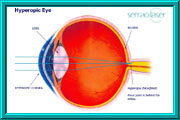 Hyperopic Eye