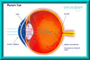 Myopic Eye